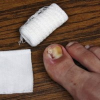 Ingrowing Toenail