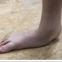 Flat Feet